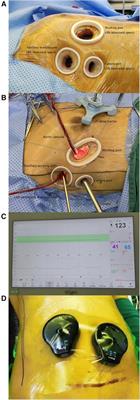 Case Report: Totally endoscopic minimally invasive mitral valve surgery during pregnancy: a case series